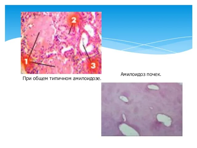 При общем типичном амилоидозе. Амилоидоз почек.