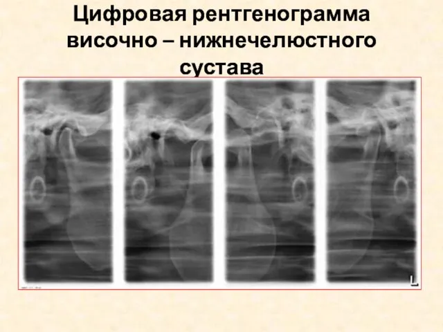 Цифровая рентгенограмма височно – нижнечелюстного сустава