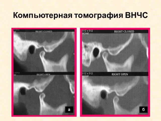 Компьютерная томография ВНЧС