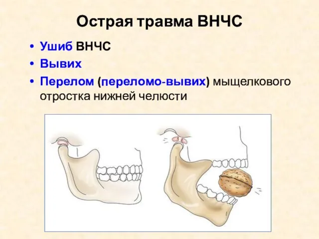 Острая травма ВНЧС Ушиб ВНЧС Вывих Перелом (переломо-вывих) мыщелкового отростка нижней челюсти