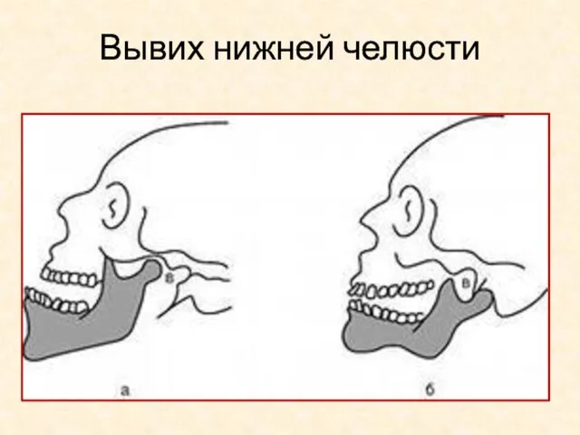 Вывих нижней челюсти