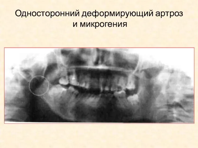 Односторонний деформирующий артроз и микрогения