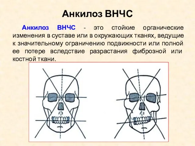 Анкилоз ВНЧС Анкилоз ВНЧС - это стойкие органические изменения в суставе