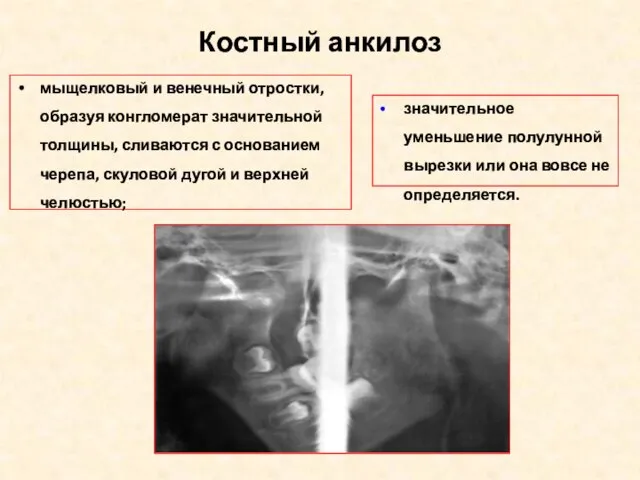 Костный анкилоз мыщелковый и венечный отростки, образуя конгломерат значительной толщины, сливаются