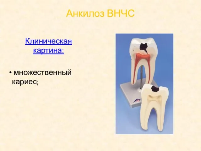 Анкилоз ВНЧС Клиническая картина: множественный кариес;