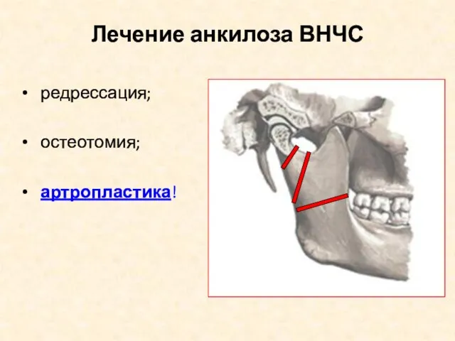 Лечение анкилоза ВНЧС редрессация; остеотомия; артропластика!