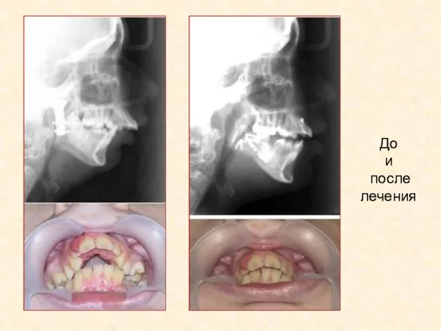 До и после лечения