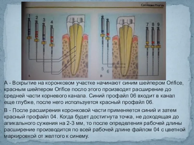 А - Вскрытие на коронковом участке начинают синим шейпером Orifice, красным