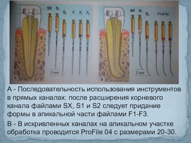 А - Последовательность использования инструментов в прямых каналах: после расширения корневого