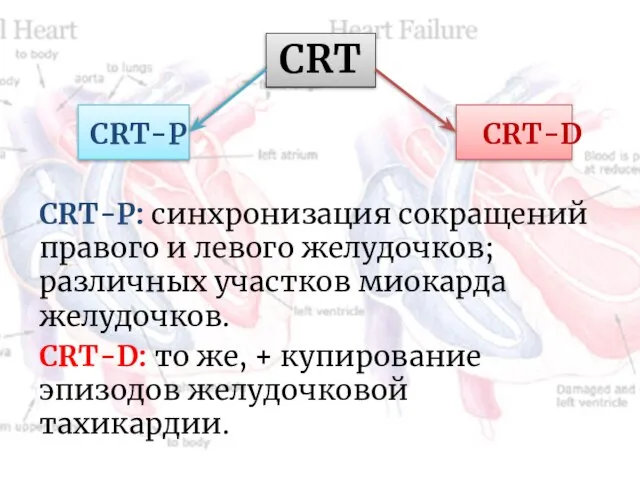 CRT CRT-P CRT-D CRT-P: синхронизация сокращений правого и левого желудочков; различных