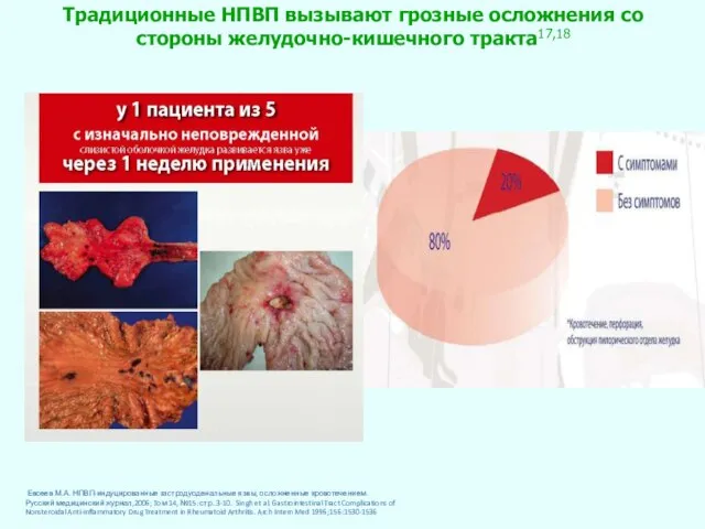 Традиционные НПВП вызывают грозные осложнения со стороны желудочно-кишечного тракта17,18 Евсеев М.А.