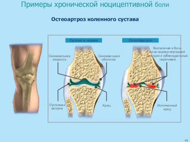 Примеры хронической ноцицептивной боли Остеоартроз коленного сустава Сустав в норме Остеоартроз