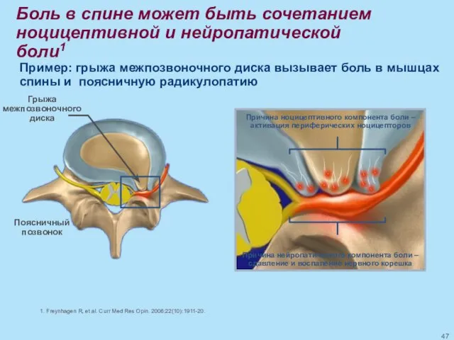 Поясничный позвонок 1. Freynhagen R, et al. Curr Med Res Opin.