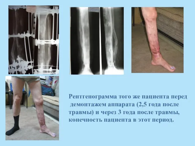 Рентгенограмма того же пациента перед демонтажем аппарата (2,5 года после травмы)