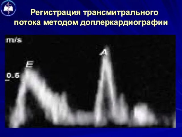 Регистрация трансмитрального потока методом доплеркардиографии