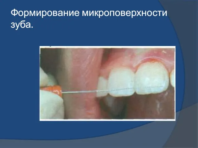 Формирование микроповерхности зуба.