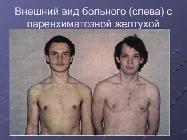 Внешний вид больного (слева) с паренхиматозной желтухой