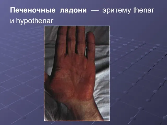 Печеночные ладони — эритему thenar и hypothenar