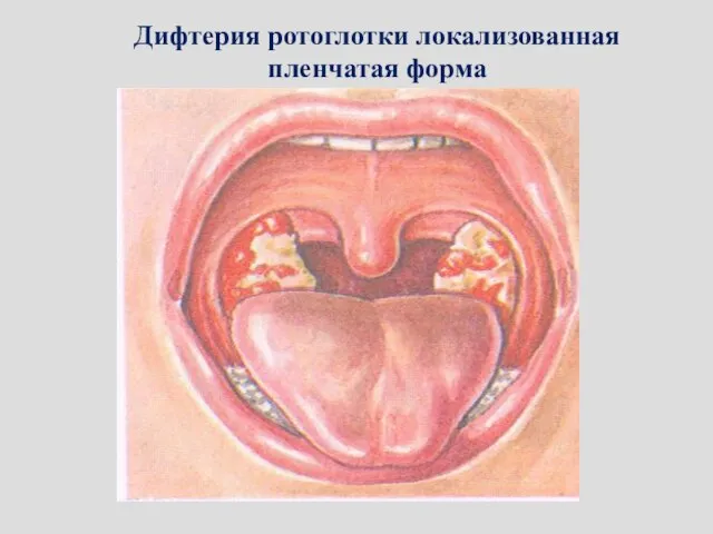 Дифтерия ротоглотки локализованная пленчатая форма