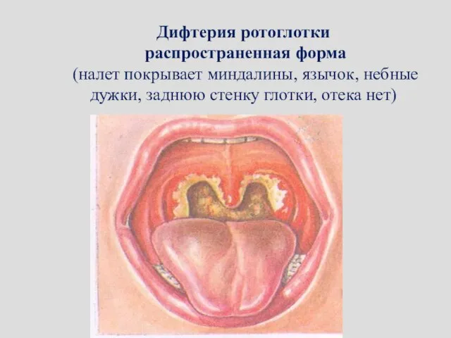 Дифтерия ротоглотки распространенная форма (налет покрывает миндалины, язычок, небные дужки, заднюю стенку глотки, отека нет)