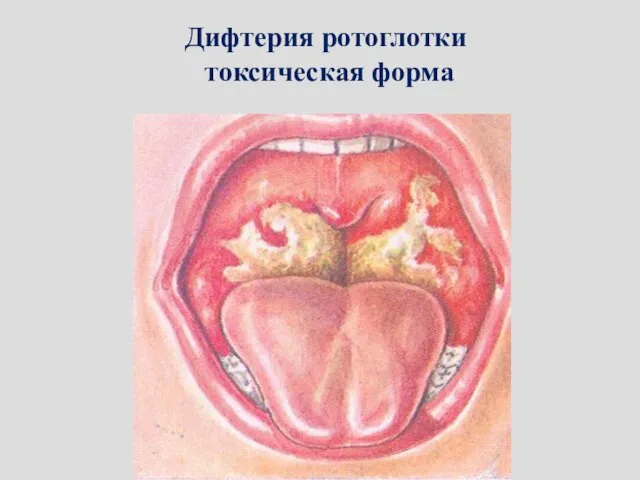 Дифтерия ротоглотки токсическая форма