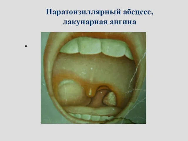 Паратонзиллярный абсцесс, лакунарная ангина