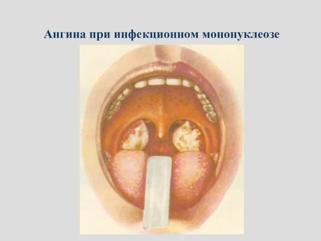 Ангина при инфекционном мононуклеозе