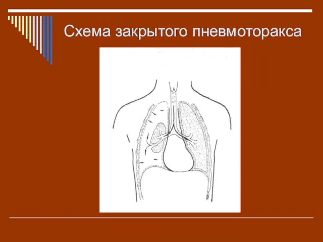 Схема закрытого пневмоторакса