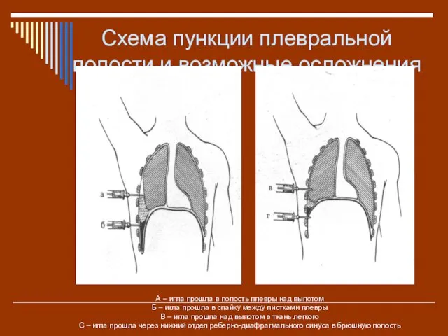 Схема пункции плевральной полости и возможные осложнения А – игла прошла