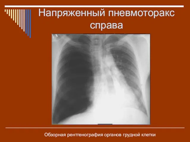 Напряженный пневмоторакс справа Обзорная рентгенография органов грудной клетки