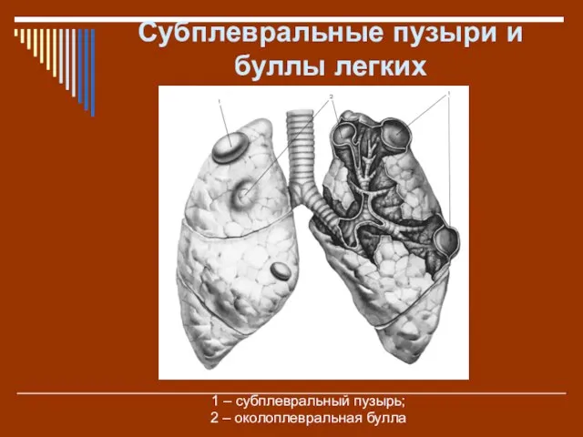 Субплевральные пузыри и буллы легких 1 – субплевральный пузырь; 2 – околоплевральная булла