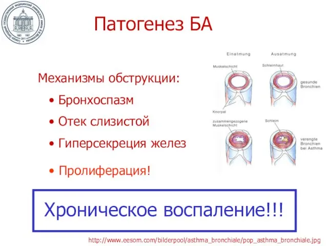 Патогенез БА Механизмы обструкции: Бронхоспазм Отек слизистой Гиперсекреция желез Пролиферация! Хроническое воспаление!!! http://www.eesom.com/bilderpool/asthma_bronchiale/pop_asthma_bronchiale.jpg