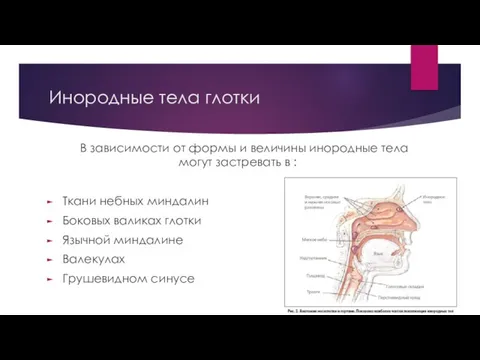 Инородные тела глотки В зависимости от формы и величины инородные тела