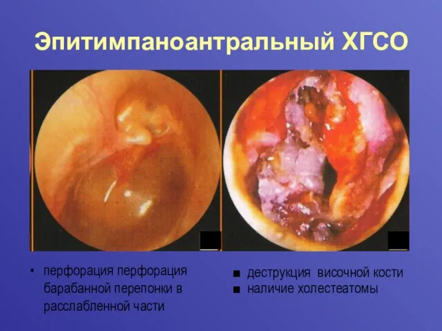 Эпитимпаноантральный ХГСО перфорация перфорация барабанной перепонки в расслабленной части деструкция височной кости наличие холестеатомы