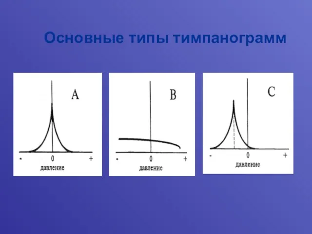 Основные типы тимпанограмм