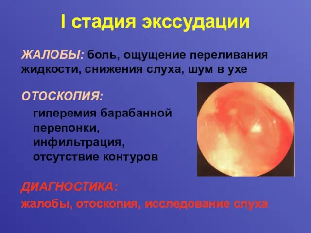 I стадия экссудации ОТОСКОПИЯ: гиперемия барабанной перепонки, инфильтрация, отсутствие контуров ДИАГНОСТИКА: