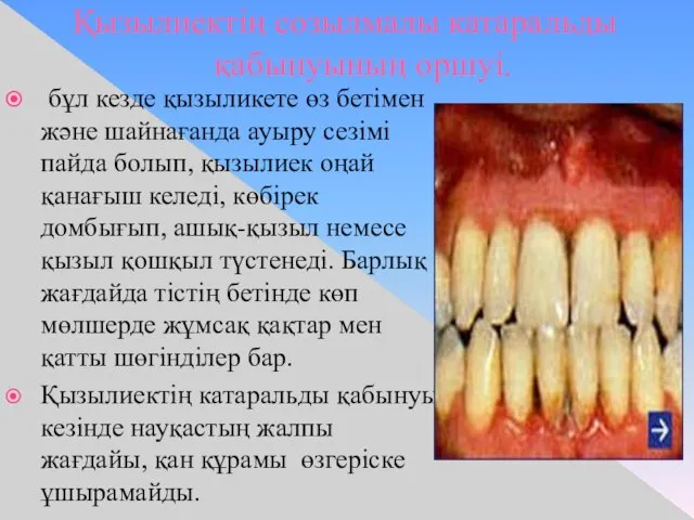 Қызылиектің созылмалы катаральды қабынуының оршуі. бұл кезде қызыликете өз бетімен және