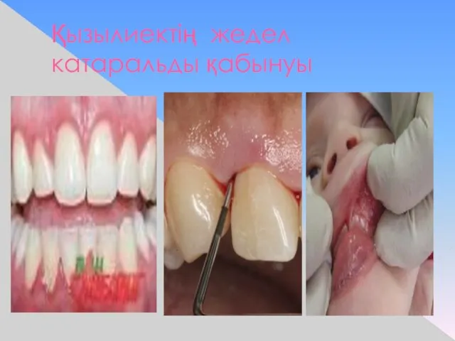 Қызылиектің жедел катаральды қабынуы