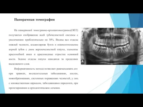 Панорамная томография На панорамной томограмме-ортопантомограмме(ОПТ) получается изображение всей зубочелюстной системы с