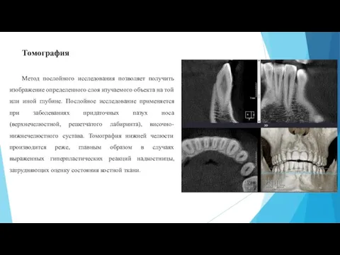 Томография Метод послойного исследования позволяет получить изображение определенного слоя изучаемого объекта