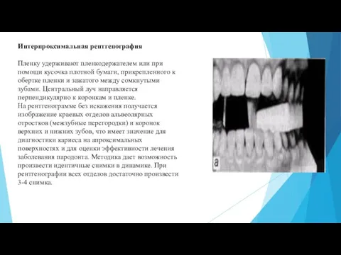 Интерпроксимальная рентгенография Пленку удерживают пленкодержателем или при помощи кусочка плотной бумаги,