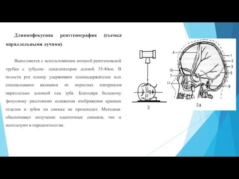 Длиннофокусная рентгенография (съемка параллельными лучами) Выполняется с использованием мощной рентгеновской трубки