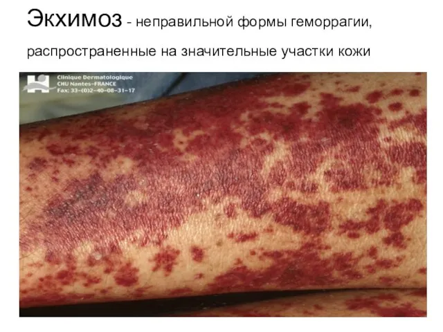 Экхимоз - неправильной формы геморрагии, распространенные на значительные участки кожи