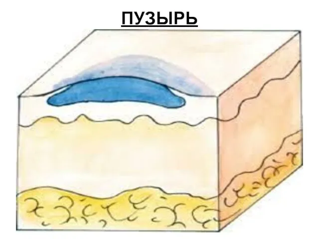 ПУЗЫРЬ