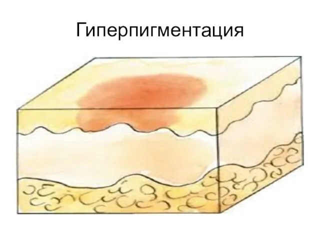 Гиперпигментация