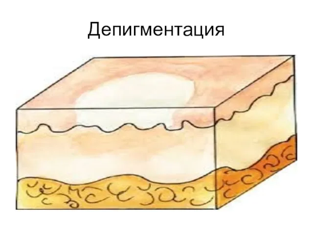 Депигментация