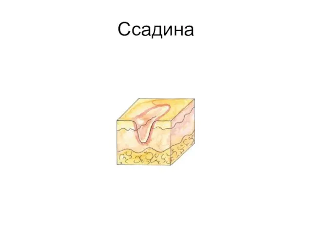 Ссадина