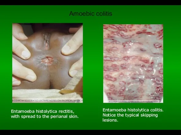 Amoebic colitis Entamoeba histolytica rectitis, with spread to the perianal skin.