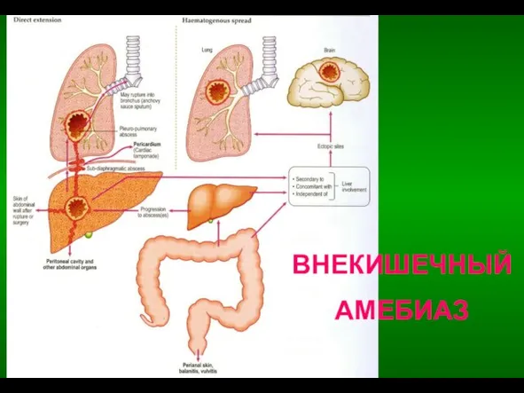 ВНЕКИШЕЧНЫЙ АМЕБИАЗ