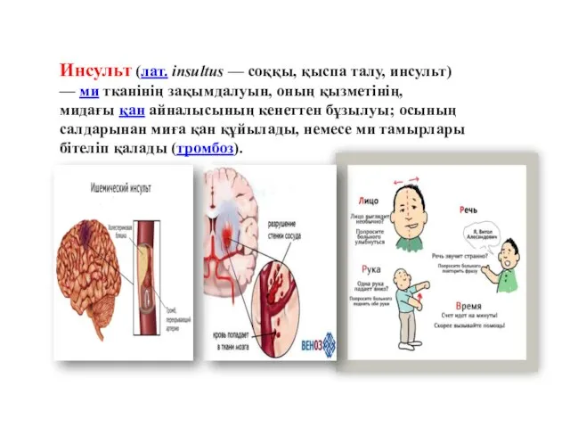 Инсульт (лат. insultus — соққы, қыспа талу, инсульт) — ми тканінің